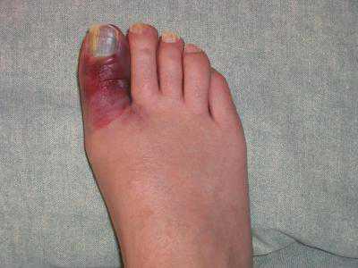 При повреждении пальца на руке или ноге боль имеет острый характер