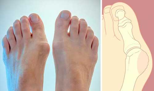 Как лечить шишку большого пальца стопы