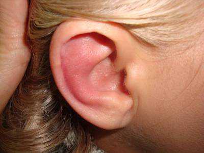 Симптоматика ой стадии температура снижается боль утихает снижение слуха продолжаетсяиз уха начинают идти гнойные выделения