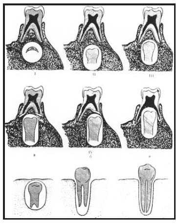 Проникновение микробных агентов в каверну зуба вероятно при глубоком кариесе, отягчении пульпит