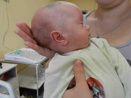 Операции, выполняемые по этому поводу достаточно простые и безопасные, однако у новорожденных их выполняют в условиях стационара